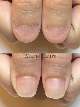 マリーロール 梅田店(Marie Laure)/自爪育成/深爪矯正/ネイルケア
