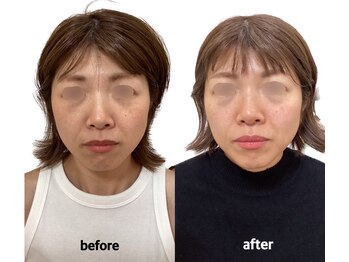 けいのき鍼灸整骨院/美容鍼3ヵ月8回の効果！美容鍼灸