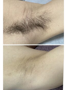 リバース 大曽根(Re.BIRTH)/BeforeAfter