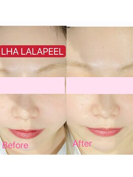 ドルチェナッツ ネオ 府内店(dolce nuts NEO)/ララピール♪ツヤ肌◎