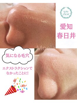 モエラビューティーサロン(Moela beauty salon)/【全顔毛穴洗浄】