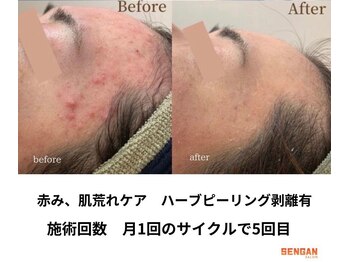 センガン(SENGAN)/剥離ハーブピーリング