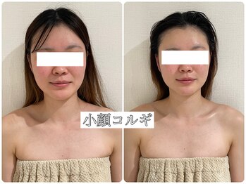 イデアルミー 大宮店(イデアルMe)/小顔コルギ1回目Before After