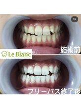 ルブラン 奈良店(Le Blanc)/セルフホワイトニングが人気