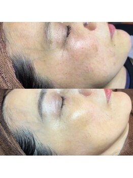 ホワラ 横浜店(Whila)/施術効果１2