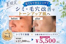 パールホワイトニング