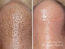 レネットサロン(Reinette Salon)の雰囲気（毛穴ケア洗浄×引き締めBBL光フェイシャル￥13,200）