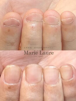 マリーロール 梅田店(Marie Laure)/自爪育成/深爪矯正/ネイルケア