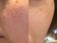 エヴェリーナ(Eveliiina)/43歳◎13回シミケア