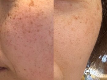 エヴェリーナ(Eveliiina)/43歳◎13回シミケア