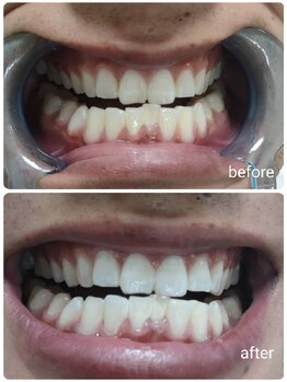 エクシアホワイトニング 新白河店/ホワイトニングビフォーアフター
