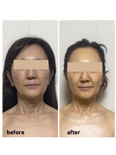 小顔専門サロン ラリューシュ(La ruche)/劇的！若見えビフォーアフター