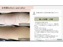 エミルカ 鹿児島店(EMILUCA)/ハーブピーリング