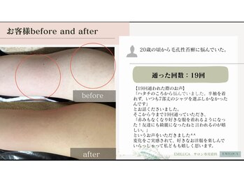 エミルカ 鹿児島店(EMILUCA)/ハーブピーリング