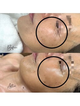 アピール(Appeal)/シワにもアプローチ!