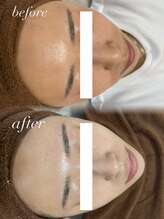 ビーグロウ(be Grow)/毛穴洗浄＋白玉ピーリング