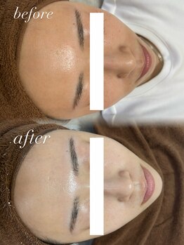 ビーグロウ(be Grow)/毛穴洗浄+白玉ピーリング