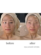 サロン ド ブラン アオヤマ(Salon de BLANC AOYAMA)/BLANC式小顔ソノケアコース