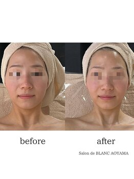 サロン ド ブラン アオヤマ(Salon de BLANC AOYAMA)/BLANC式小顔ソノケアコース