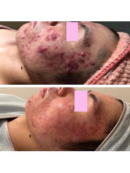 サロン ラズリ 久留米店(SALON Lazuli)/【イオン導入】毛穴/ニキビ