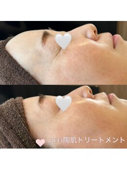 アンドリノ(&LINO)/シワ改善コース