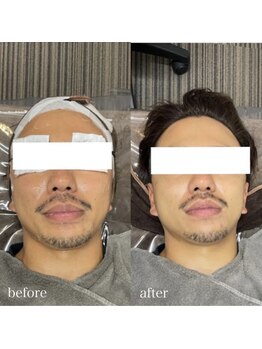 ホッコリ 段原店(HOKKORI)/効果実感No.1BBL光フェイシャル