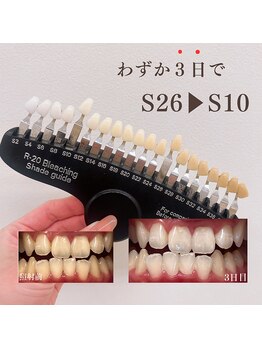 ブリエ(BRILLER)/《医》高効果ホワイトニング症例