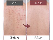 フルリール/【背中トリートメント】