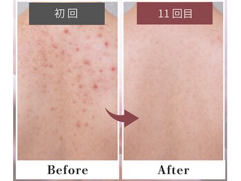 フルリール/【背中トリートメント】