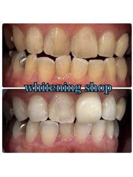 ホワイトニングショップ 池田店/【BEFORE/AFTER】