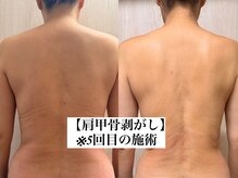 バービーグロウ 恵比寿(Barbie Glow)/肩甲骨剥がし5回目