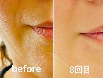 RKボディアンドフェイシャルサロン(RK body&facial salon)の写真/老け顔脱出をサポート！セルラムで細胞からアプローチ。たるみやエイジング悩みへハリツヤ溢れる肌へ♪