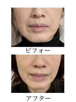 プルミエ/美容鍼　ビフォーアフター