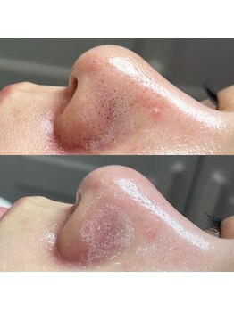 エミュ(emu)/毛穴エクストラクション