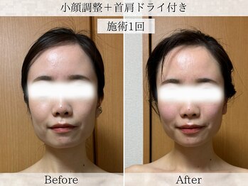 フラリ 西葛西(Hulali)/【30代】むくみたるみケア1回目