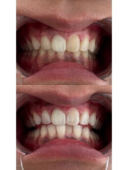 アレッド 大阪店(ared.)/大人気ホワイトニング