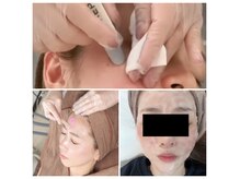 クレンジング→ワックス脱毛→毛穴洗浄→炭酸ガスパック9,900円!