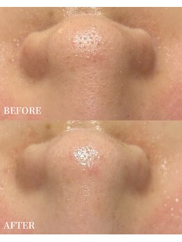 エース(ACE.)/肌のザラつき、くすみ改善!