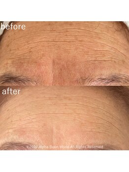 フジモトサロン 那覇おもろまち店(fujimotoサロン)/シワに特化したケア♪