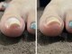 ラフィング(Laughing)の写真/巻き爪の痛みを根元からサポート。信頼の矯正施術!ネイルサロンだからできる最新施術が話題！！