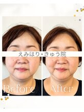 えみはりきゅう院/プレミアム電気美容鍼