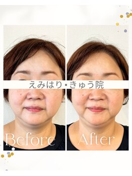 えみはりきゅう院/プレミアム電気美容鍼