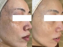 エヴェリーナ(Eveliiina)/40代シミケア／フェイシャル