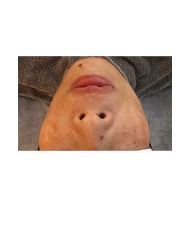 アンサー(ANSWER)/症例写真、大人女性の肌育プラン