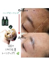 ルミナエステ(LUMINA ESTH)/ハーブピーリング／川口