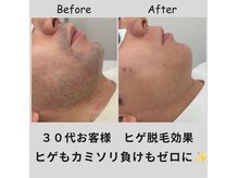 エピリス(EPILIS)の雰囲気（サロン人気NO1メニュー！ヒゲ脱毛☆同時に肌トラブルもゼロへ！）