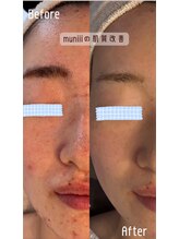 ムニ(muniii)/肌質改善コース
