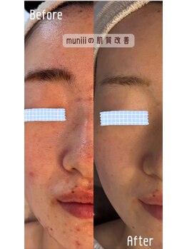 ムニ(muniii)/肌質改善コース