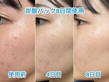 プライベートエステティックサロン クール(Coeur)/お家ケアパック【炭酸パック】