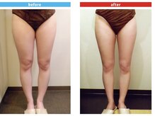 ビューティ ケア ルーム メロウ(Beauty Care Room Moelleux)/痩身before&after